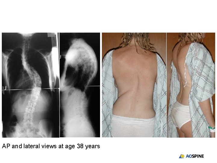 AP and lateral views at age 38 years 