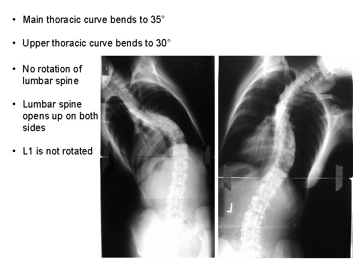  • Main thoracic curve bends to 35° • Upper thoracic curve bends to