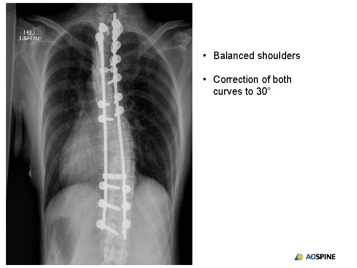  • Balanced shoulders • Correction of both curves to 30° 
