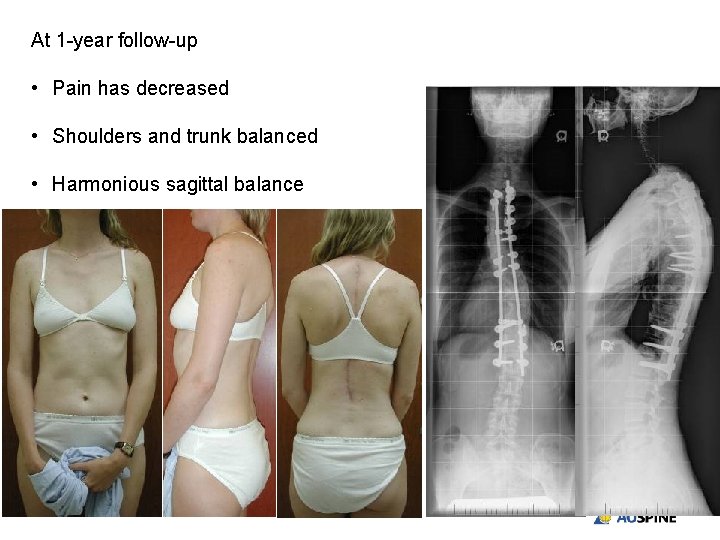 At 1 -year follow-up • Pain has decreased • Shoulders and trunk balanced •