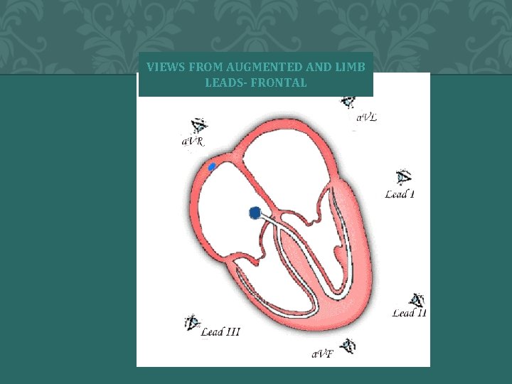 VIEWS FROM AUGMENTED AND LIMB LEADS- FRONTAL � 2004 Anna Story 19 