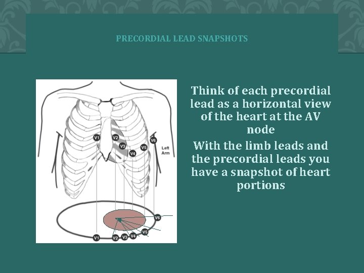 PRECORDIAL LEAD SNAPSHOTS Think of each precordial lead as a horizontal view of the