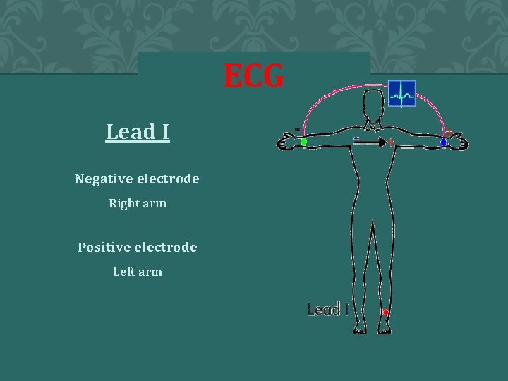 ECG Lead I Negative electrode Right arm Positive electrode Left arm 