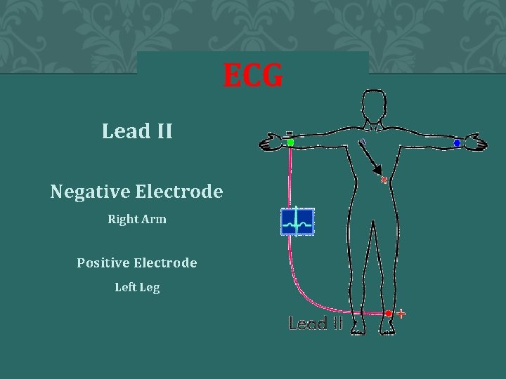 ECG Lead II Negative Electrode Right Arm Positive Electrode Left Leg 