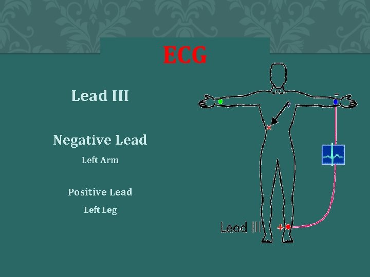 ECG Lead III Negative Lead Left Arm Positive Lead Left Leg 