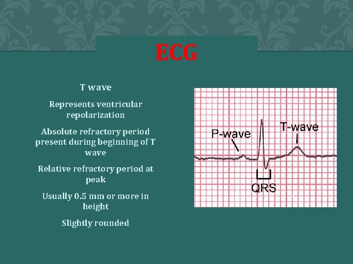 ECG T wave Represents ventricular repolarization Absolute refractory period present during beginning of T