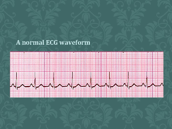 A normal ECG waveform 