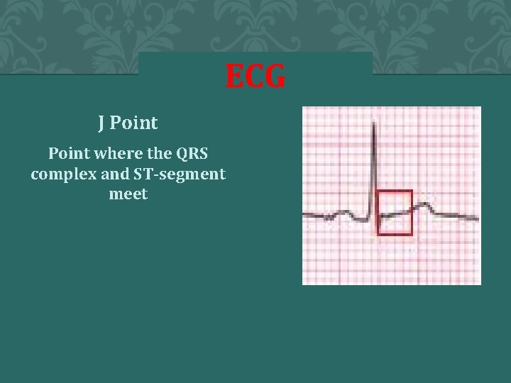 ECG J Point where the QRS complex and ST-segment meet 
