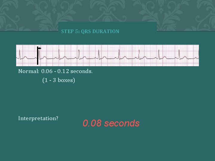 STEP 5: QRS DURATION Normal: 0. 06 - 0. 12 seconds. (1 - 3