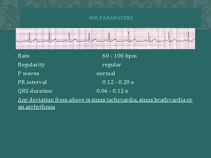 NSR PARAMETERS Rate 60 - 100 bpm Regularity regular P waves normal PR interval