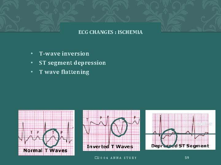 ECG CHANGES : ISCHEMIA • T-wave inversion • ST segment depression • T wave