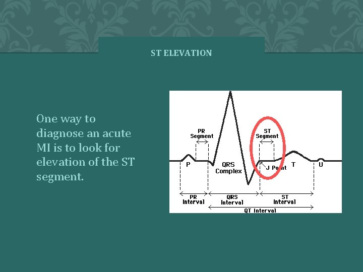 ST ELEVATION One way to diagnose an acute MI is to look for elevation