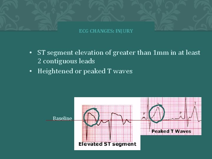 ECG CHANGES: INJURY • ST segment elevation of greater than 1 mm in at