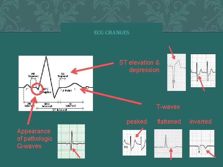 ECG CHANGES Ways the ECG can change include: ST elevation & depression T-waves peaked