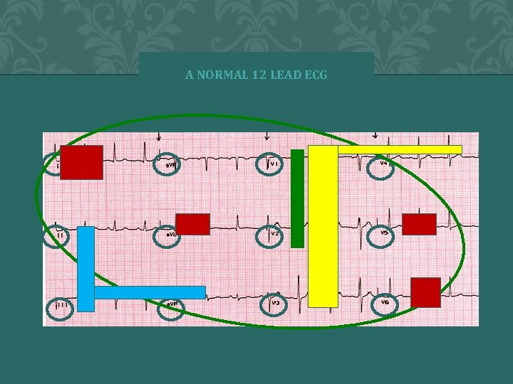 A NORMAL 12 LEAD ECG 66 