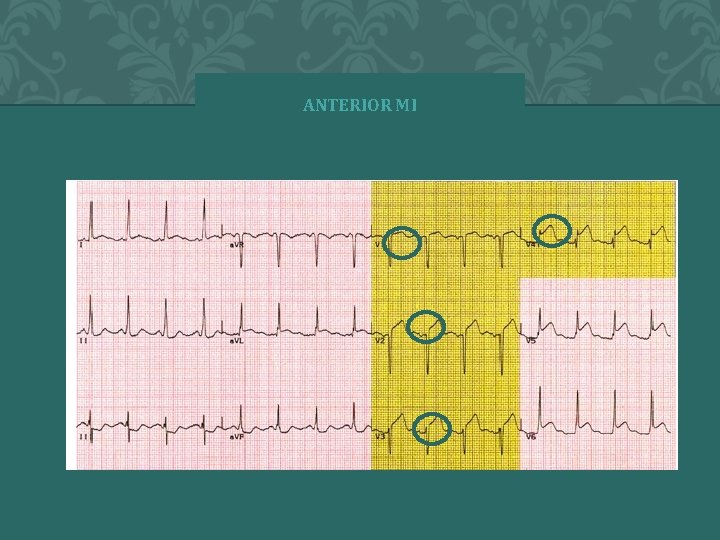 ANTERIOR MI � 2 0 0 4 A N N A S T O