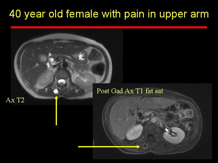 40 year old female with pain in upper arm Post Gad Ax T 1