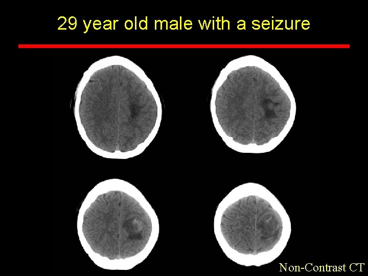 29 year old male with a seizure Non-Contrast CT 