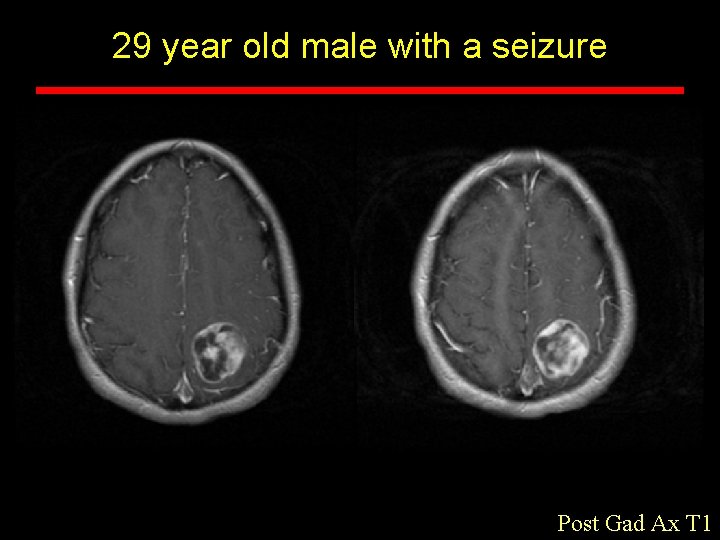 29 year old male with a seizure Post Gad Ax T 1 