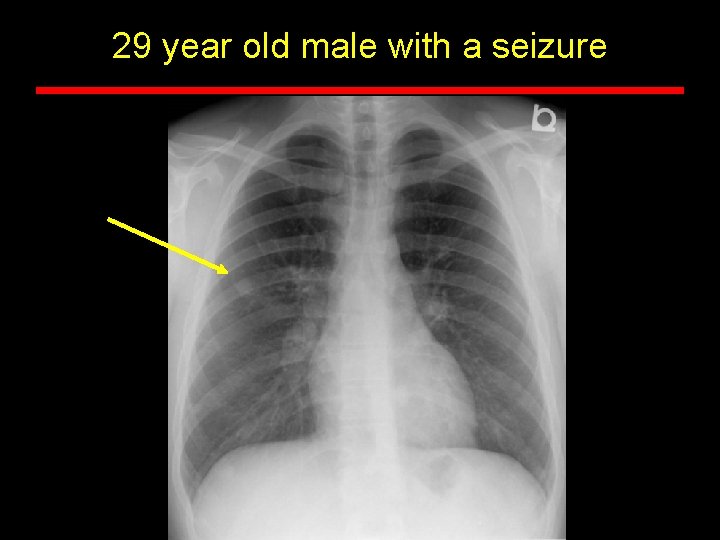 29 year old male with a seizure 
