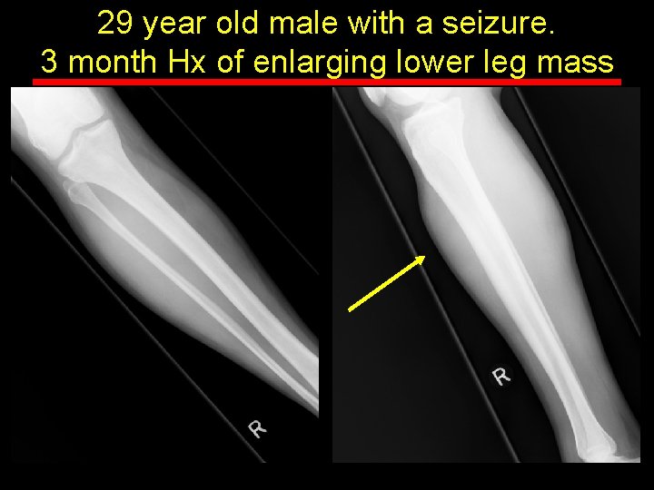 29 year old male with a seizure. 3 month Hx of enlarging lower leg