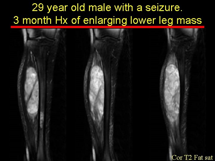 29 year old male with a seizure. 3 month Hx of enlarging lower leg