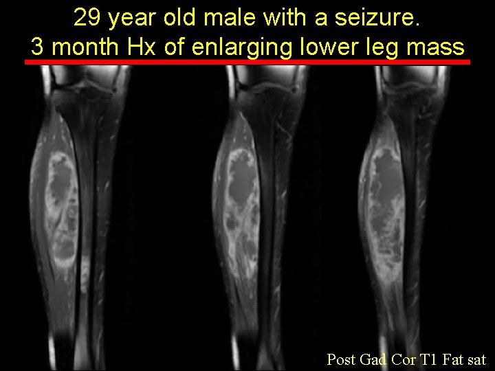29 year old male with a seizure. 3 month Hx of enlarging lower leg