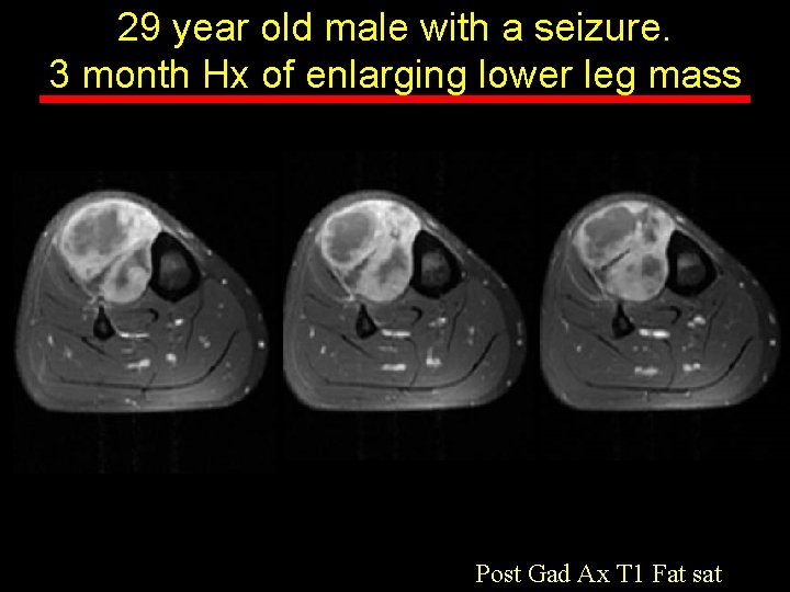 29 year old male with a seizure. 3 month Hx of enlarging lower leg