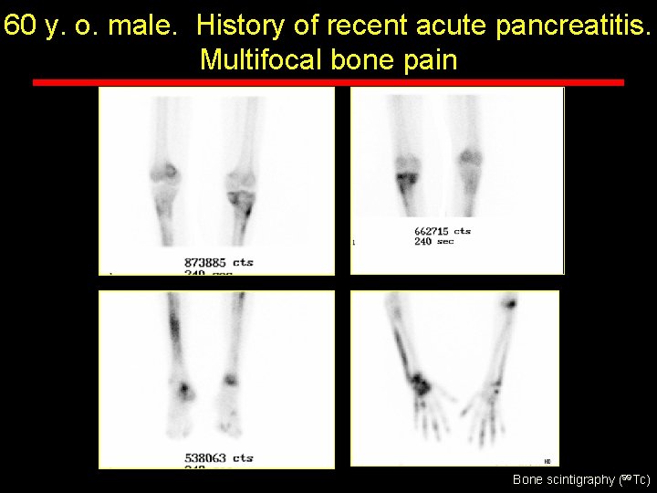 60 y. o. male. History of recent acute pancreatitis. Multifocal bone pain Bone scintigraphy