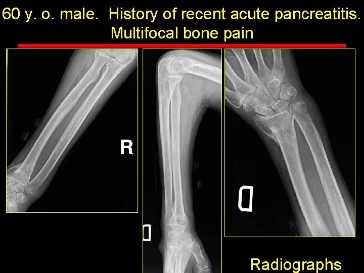 60 y. o. male. History of recent acute pancreatitis. Multifocal bone pain Radiographs 