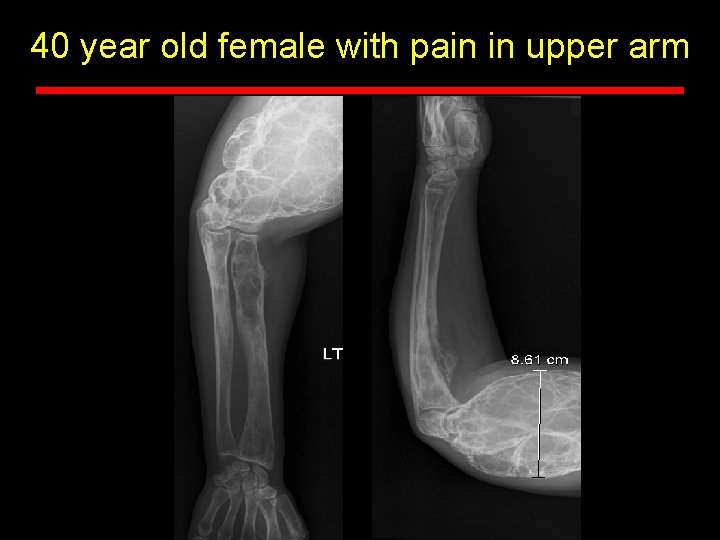 40 year old female with pain in upper arm 