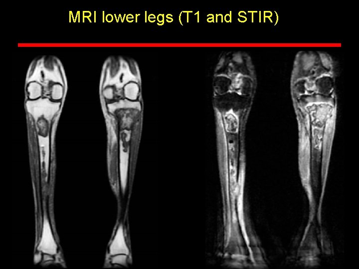 MRI lower legs (T 1 and STIR) 