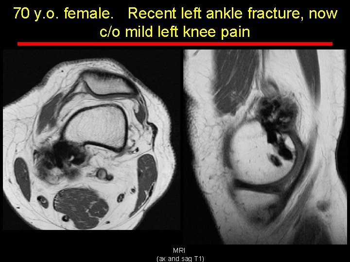 70 y. o. female. Recent left ankle fracture, now c/o mild left knee pain