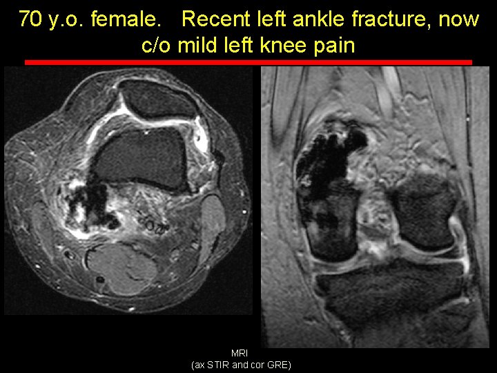 70 y. o. female. Recent left ankle fracture, now c/o mild left knee pain