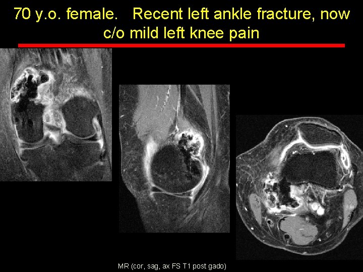 70 y. o. female. Recent left ankle fracture, now c/o mild left knee pain