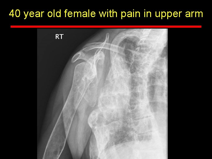 40 year old female with pain in upper arm 