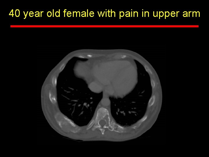 40 year old female with pain in upper arm 