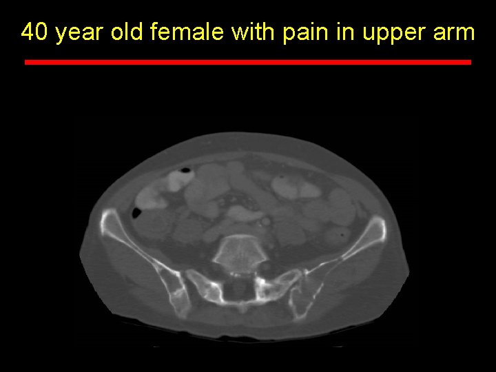 40 year old female with pain in upper arm 