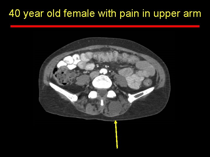 40 year old female with pain in upper arm 