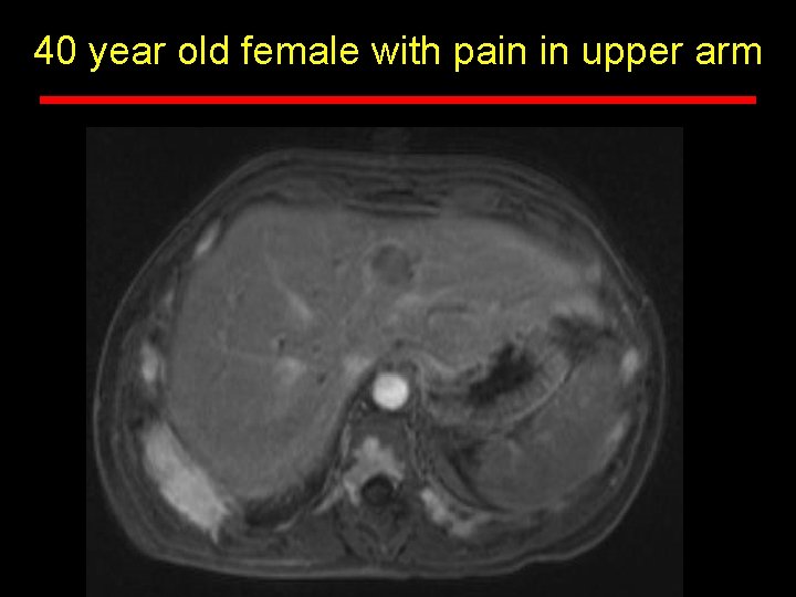 Postyear Gad Axold T 1 fatfemale sat 40 with pain in upper arm 