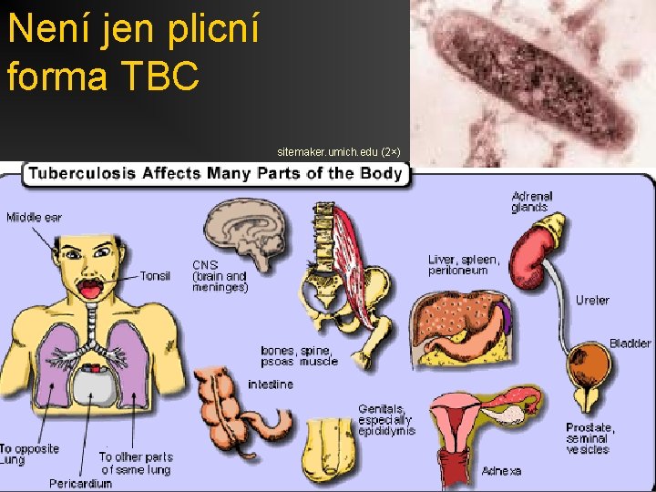 Není jen plicní forma TBC sitemaker. umich. edu (2×) 