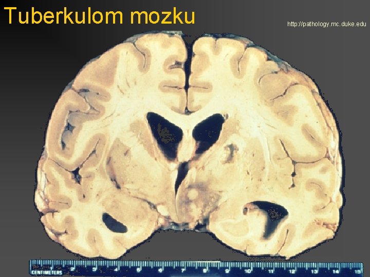 Tuberkulom mozku http: //pathology. mc. duke. edu 