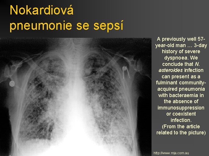 Nokardiová pneumonie se sepsí A previously well 57 year-old man … 3 -day history