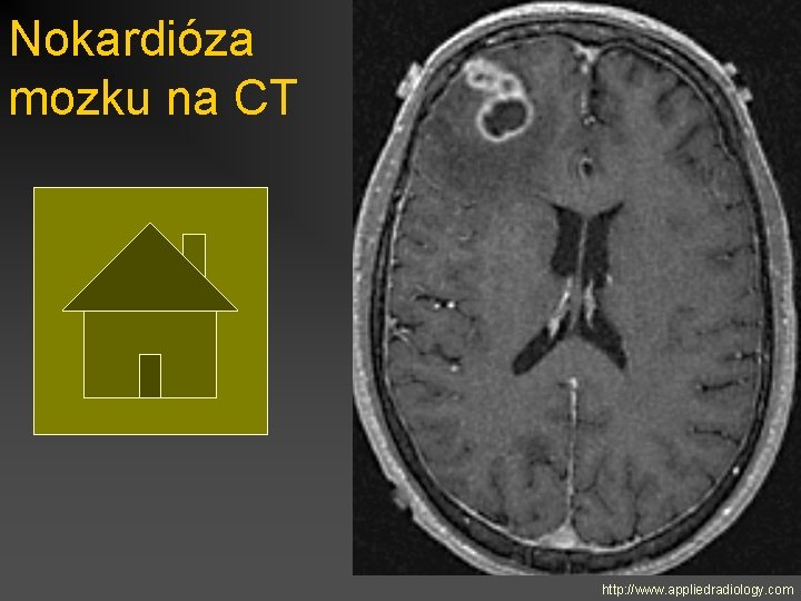 Nokardióza mozku na CT http: //www. appliedradiology. com 