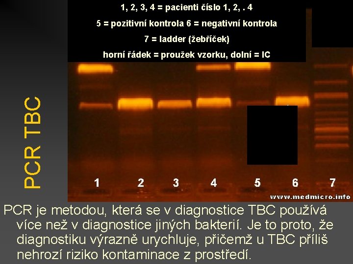 1, 2, 3, 4 = pacienti číslo 1, 2, . 4 5 = pozitivní