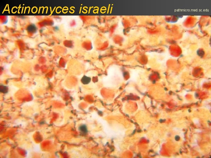 Actinomyces israeli pathmicro. med. sc. edu 