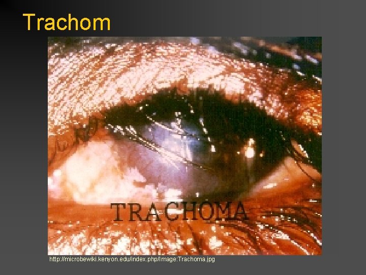 Trachom http: //microbewiki. kenyon. edu/index. php/Image: Trachoma. jpg 