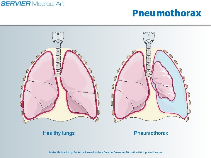 Pneumothorax Healthy lungs Pneumothorax Servier Medical Art by Servier is licensed under a Creative