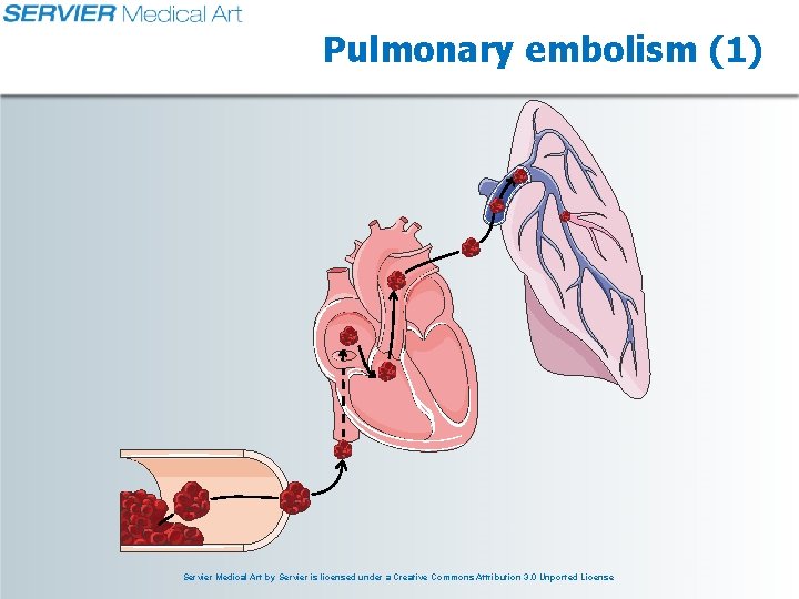 Pulmonary embolism (1) Servier Medical Art by Servier is licensed under a Creative Commons