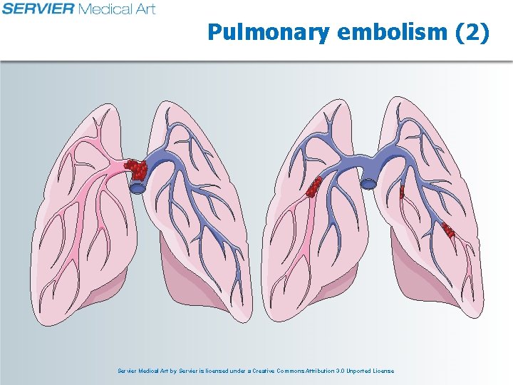 Pulmonary embolism (2) Servier Medical Art by Servier is licensed under a Creative Commons